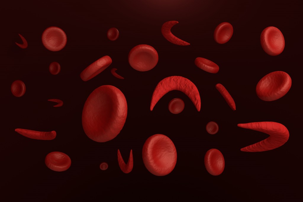 Cannabidiol CBD: Sickle Cell Anemia